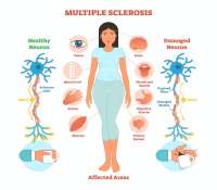 16 علائم اولیه مالتیپل اسکلروزیس (ام اس)