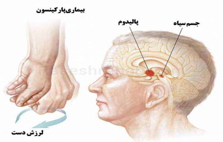 ریز نوشتن و سایر نشانه های اولیه پارکینسون