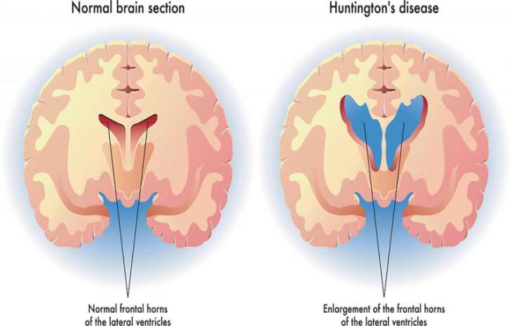 آشنایی کامل با بیماری هانتینگتون
